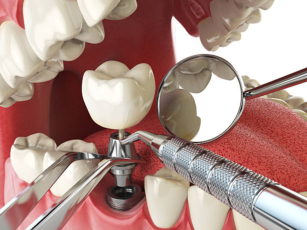 Best Emergency Wisdom Tooth Extraction in Mcminnville, OR